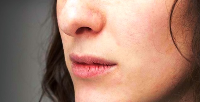 Rahasia Bibir Sehat Sepanjang Musim Dingin Panduan Lengkap Cara Mengatasi Bibir Pecah Pecah Di Cuaca Dingin